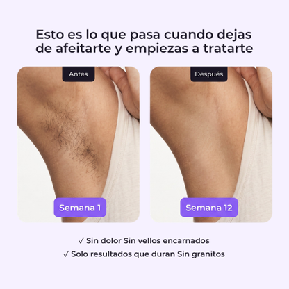 Glowi™ Depiladora Láser IPL